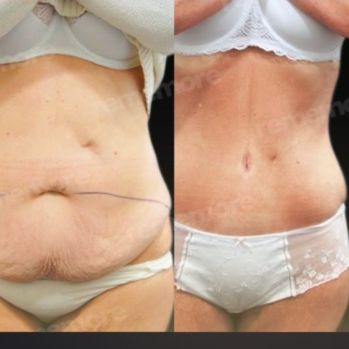 Resultados antes y después de abdominoplastia Fleur De Lis en Memorial Ankara Hospital, abdomen