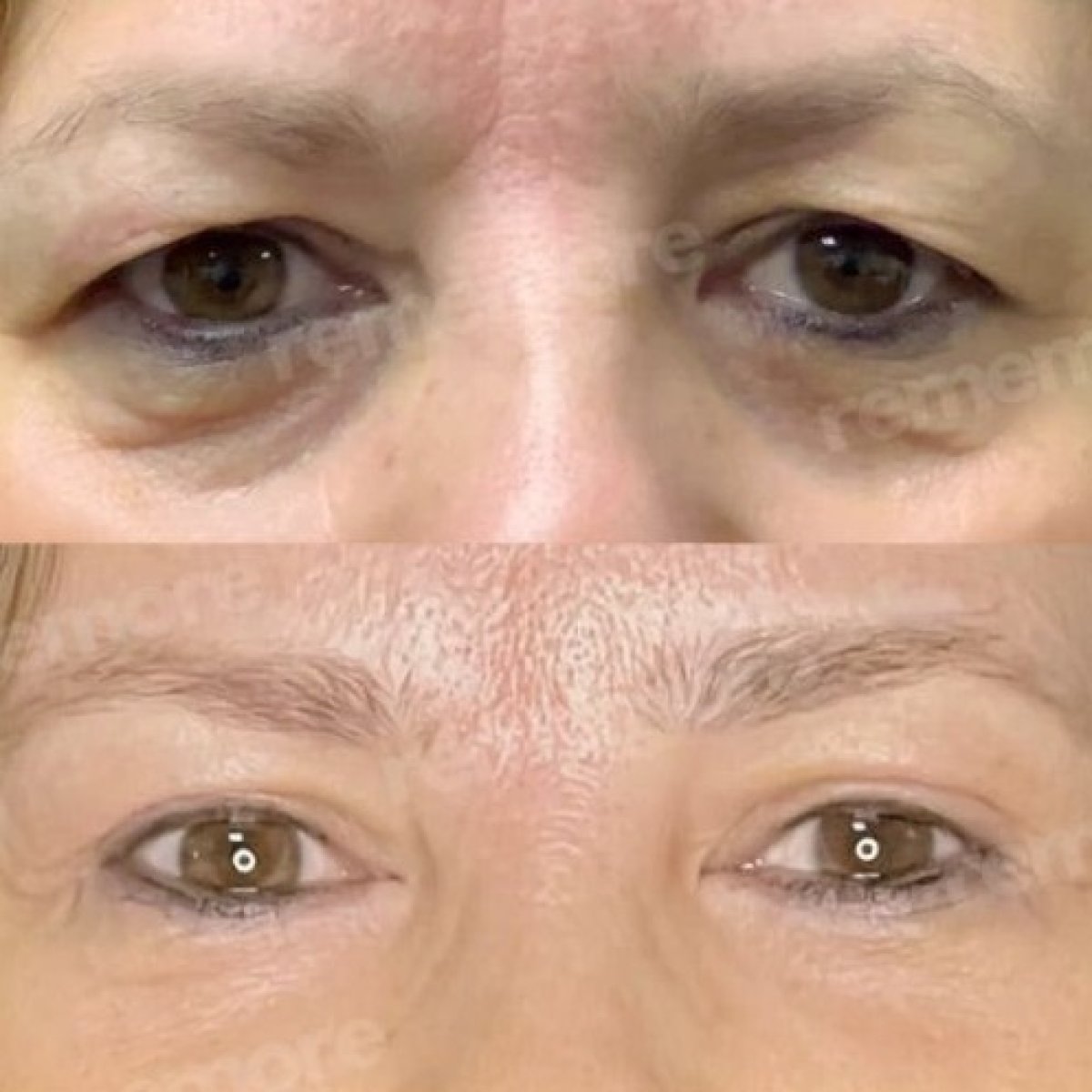 Before and after upper and lower eyelid surgery results at Memorial Bahçelievler Hospital