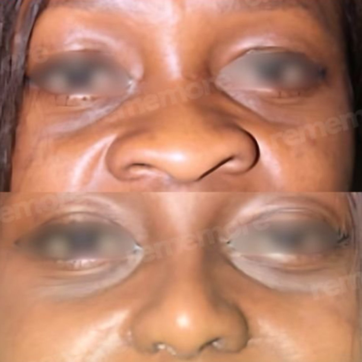 Before and after revision rhinoplasty results at Memorial Şişli Hospital, improved nose shape