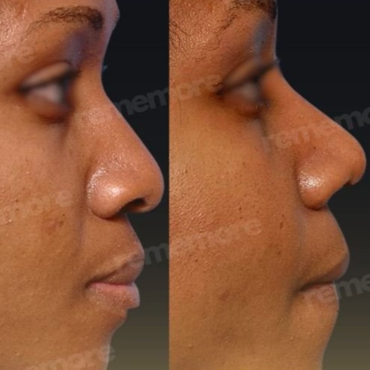 Revision rhinoplasty before and after results at Memorial Şişli Hospital, improved nose shape