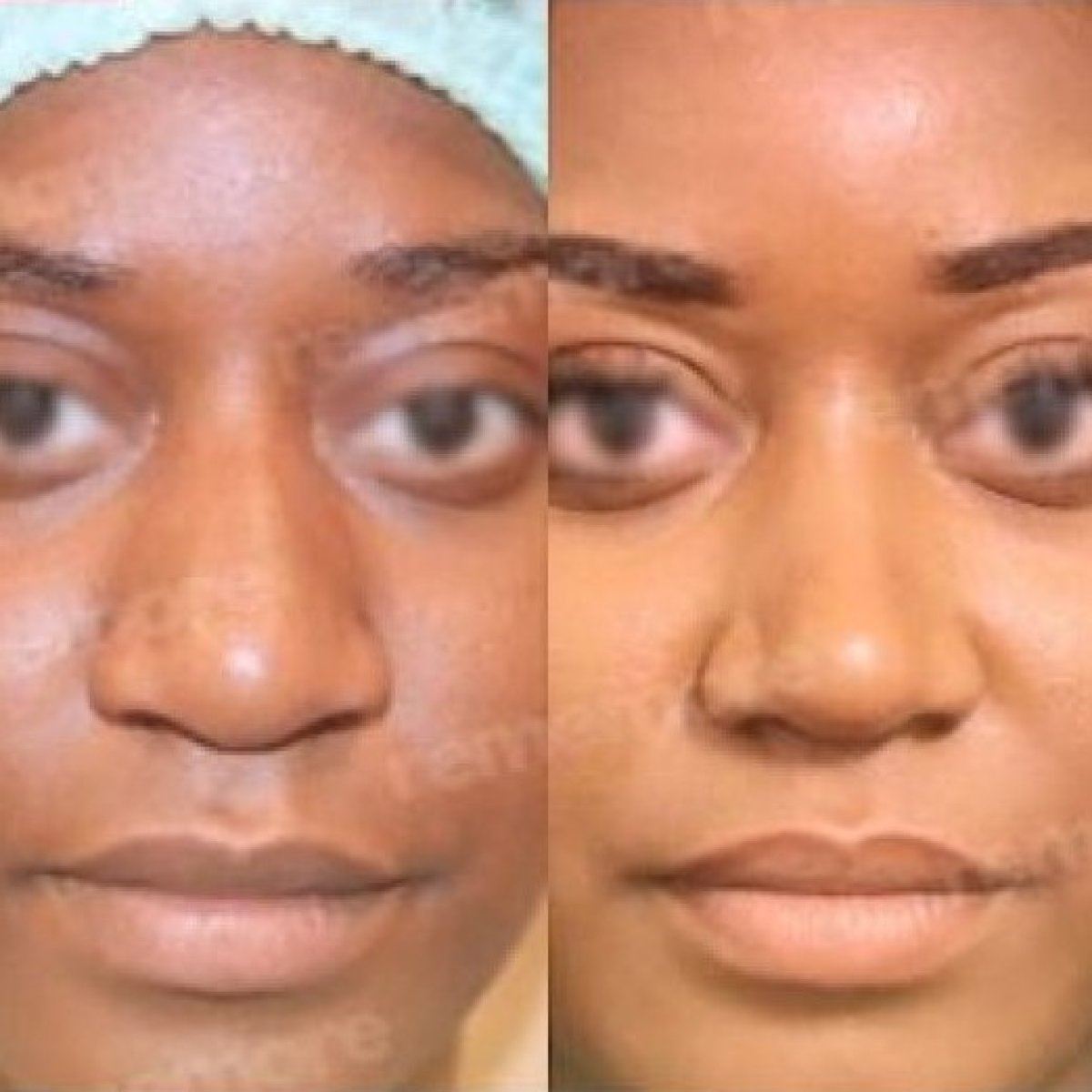 Revision rhinoplasty before and after results at Memorial Şişli Hospital, improved nose shape