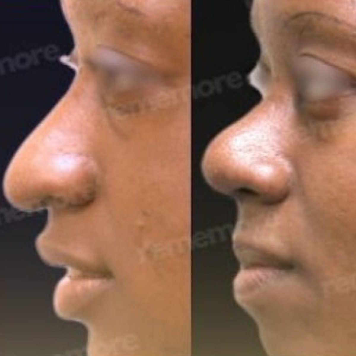Before and after revision rhinoplasty results at Memorial Şişli Hospital, improved nose shape