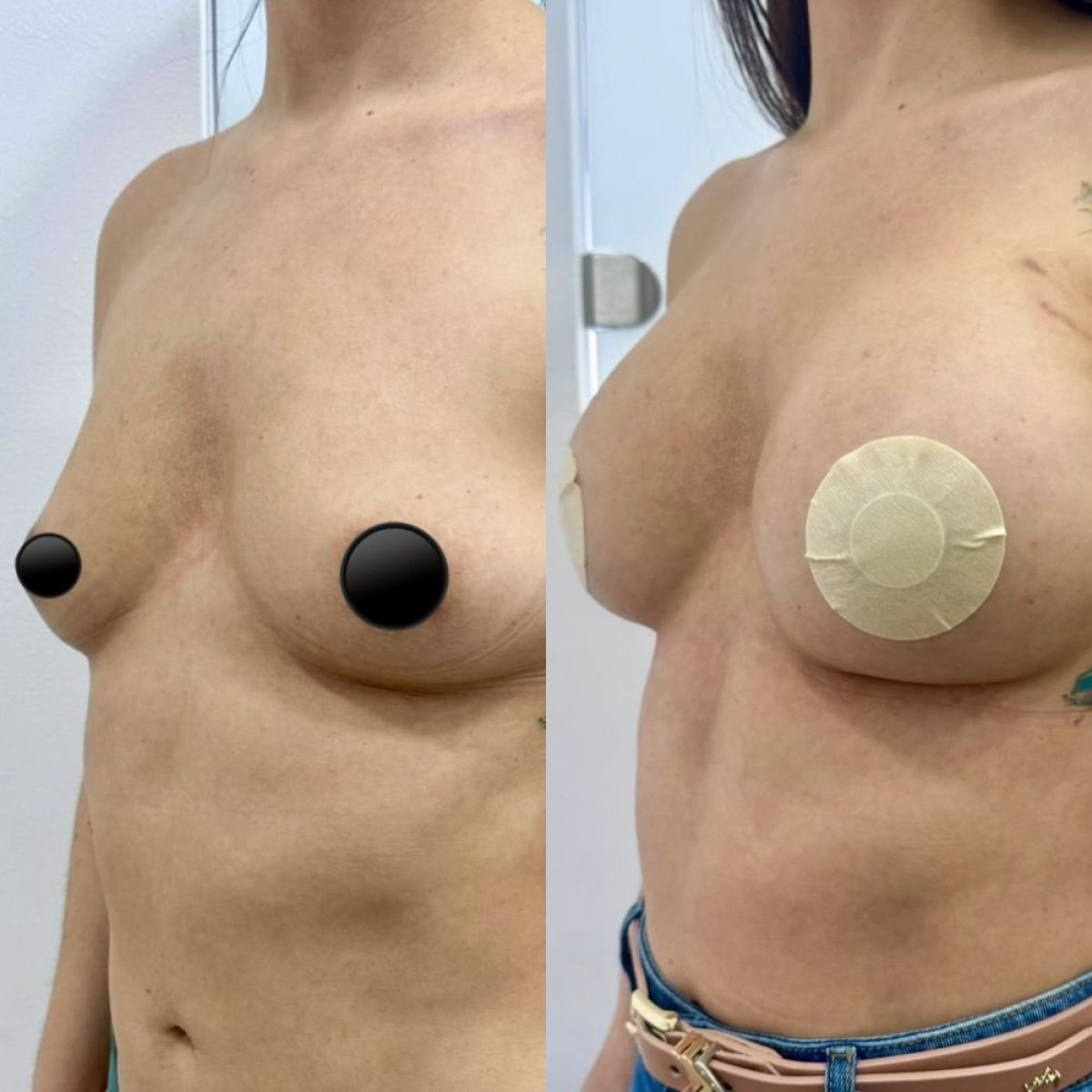 Результаты до и после подтяжки груди в Lucio Santos Plastic Surgery, улучшенный контур