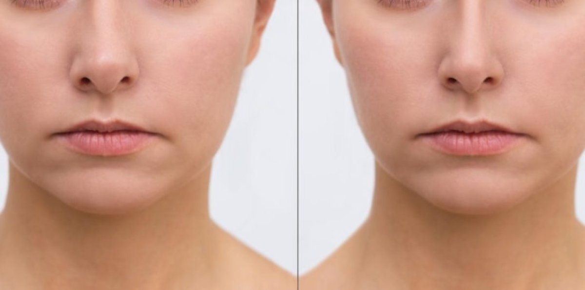 Facelift before and after results – visible jawline and skin tightening improvement