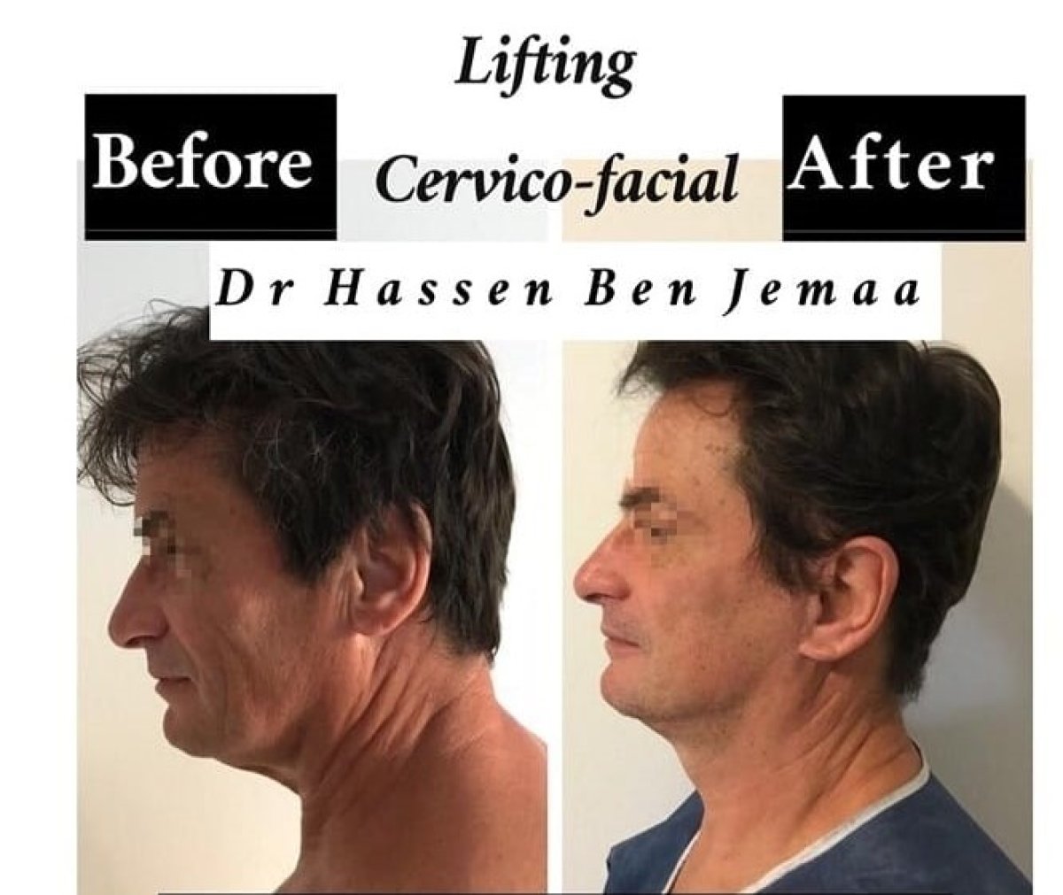 Before and after cervico-facial facelift results by Dr Hassen Ben Jemaa – visible neck lift