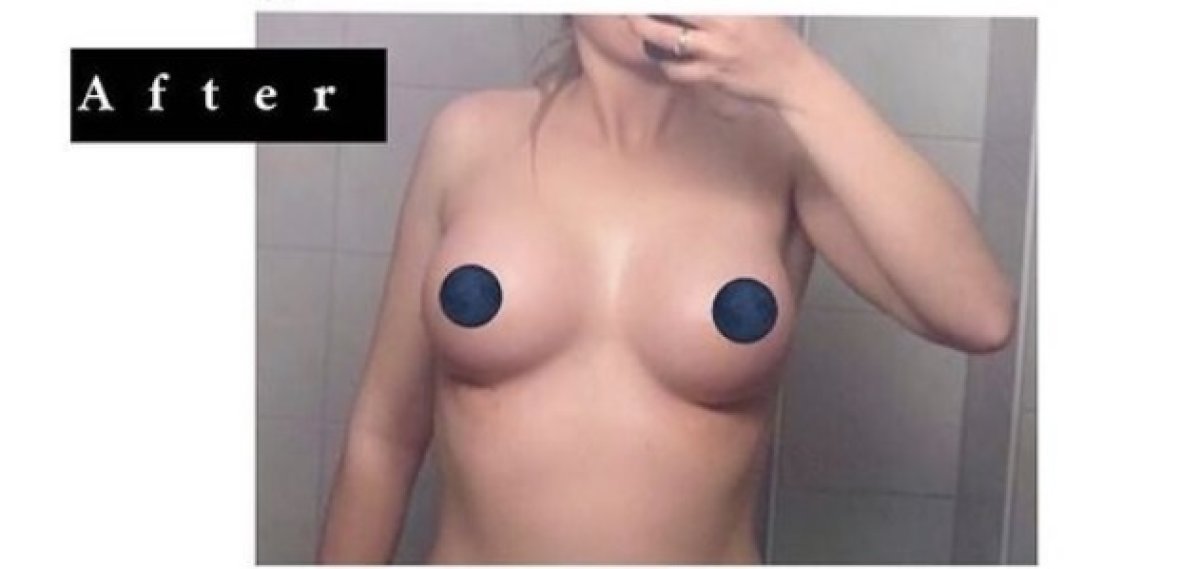 Résultat d’augmentation mammaire avec implants en goutte, contour naturel visible