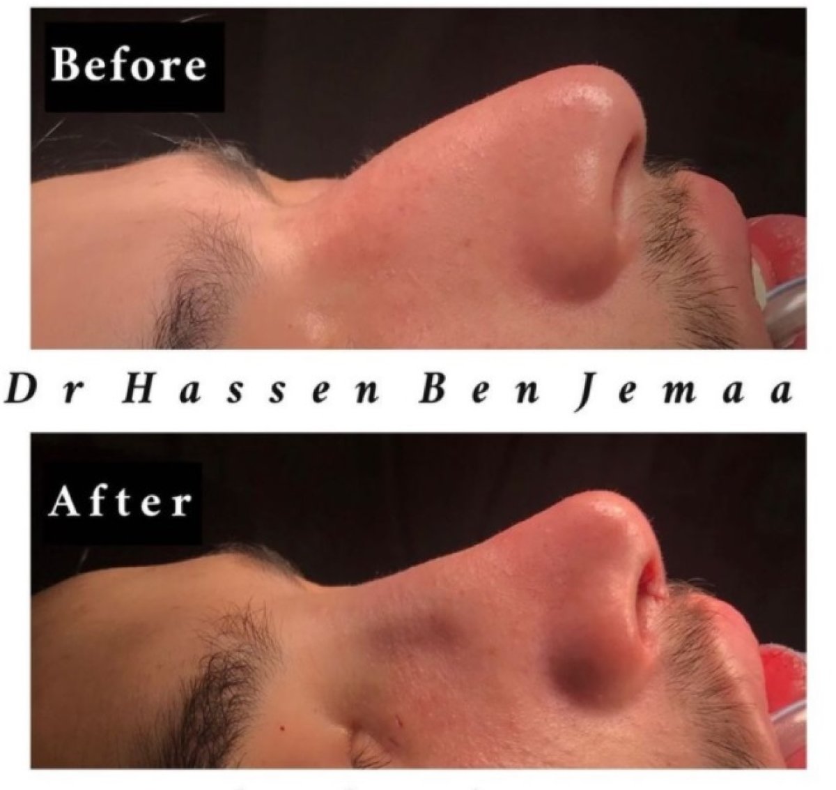 Résultats avant/après rhinoplastie par Dr Hassen Ben Jemaa, profil du nez amélioré