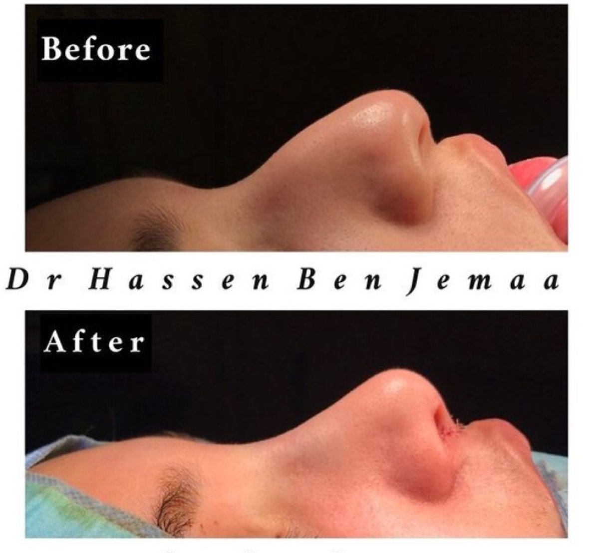 Результаты ринопластики до и после у Dr Hassen Ben Jemaa – улучшенный профиль носа