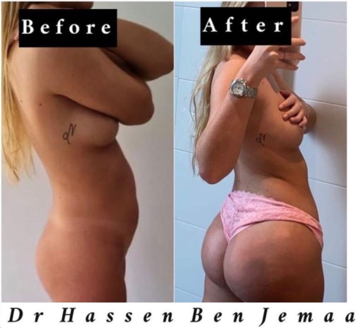 Результаты липосакции и BBL до и после у Dr Hassen Ben Jemaa – улучшенный контур тела