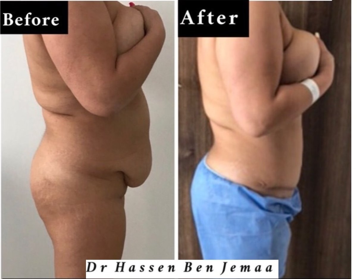 Before and after tummy tuck results by Dr Hassen Ben Jemaa – flatter abdomen and contour