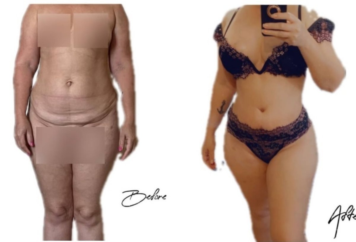 Before and after tummy tuck results – visible abdominal contour improvement after surgery