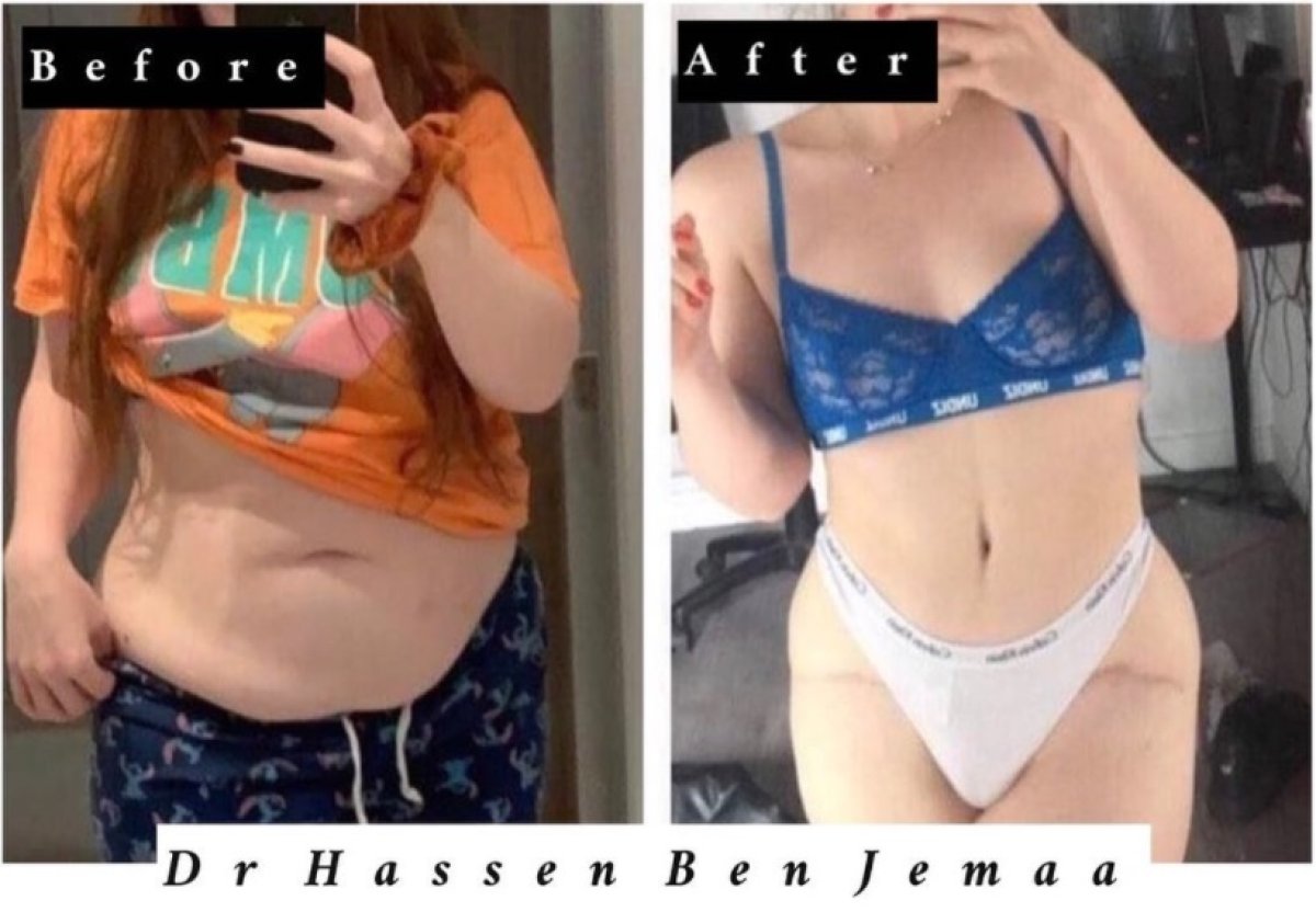 Результаты абдоминопластики до и после у Dr Hassen Ben Jemaa – видимый контур живота