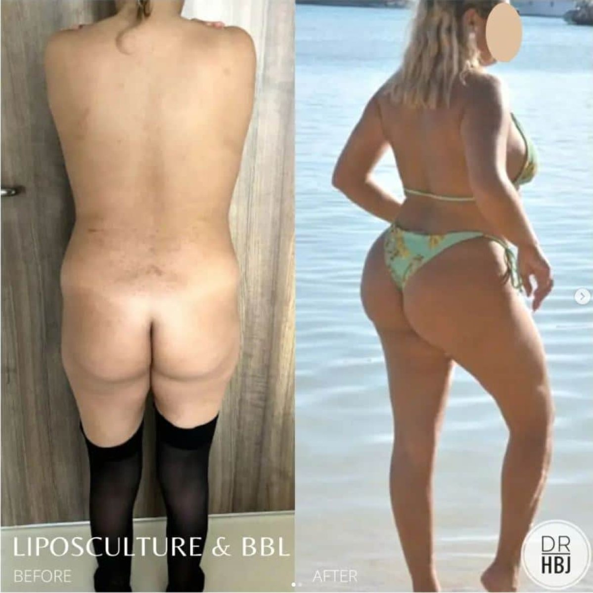 Resultados antes y después de lifting de glúteos y BBL – curvas y contorno mejorados