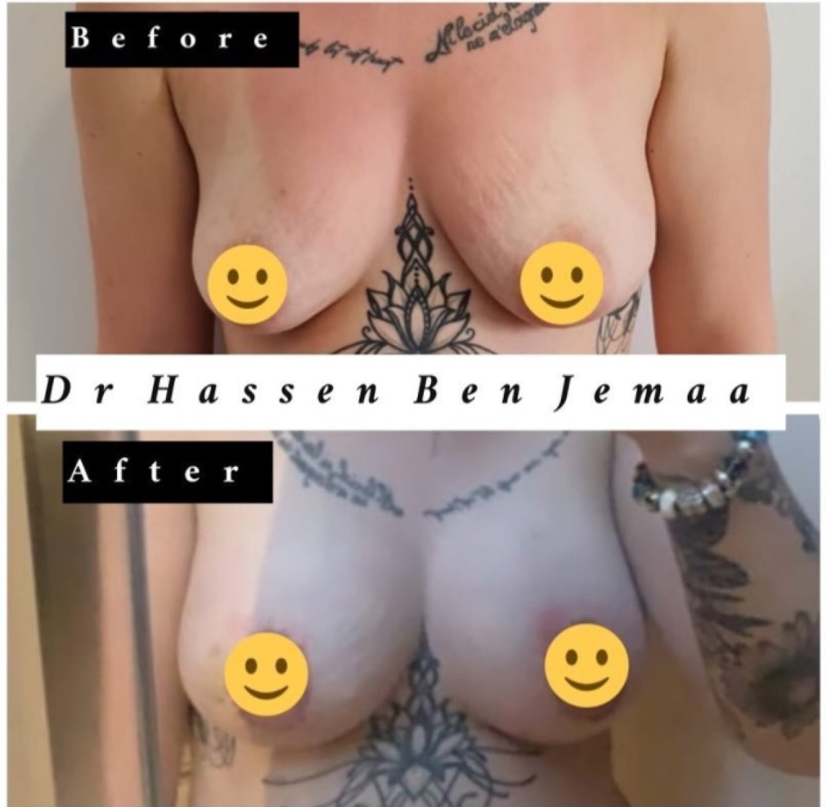 Resultados de aumento de senos antes y después con Dr Hassen Ben Jemaa – senos más llenos