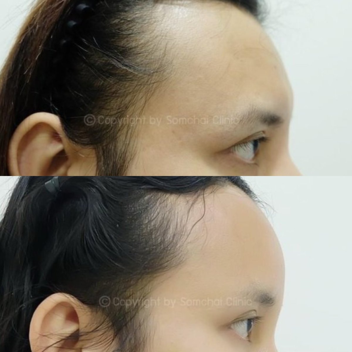 Vorher-nachher-Ergebnis Stirnaugmentation (Implantat) bei Somchai Clinic, verbesserte Kontur