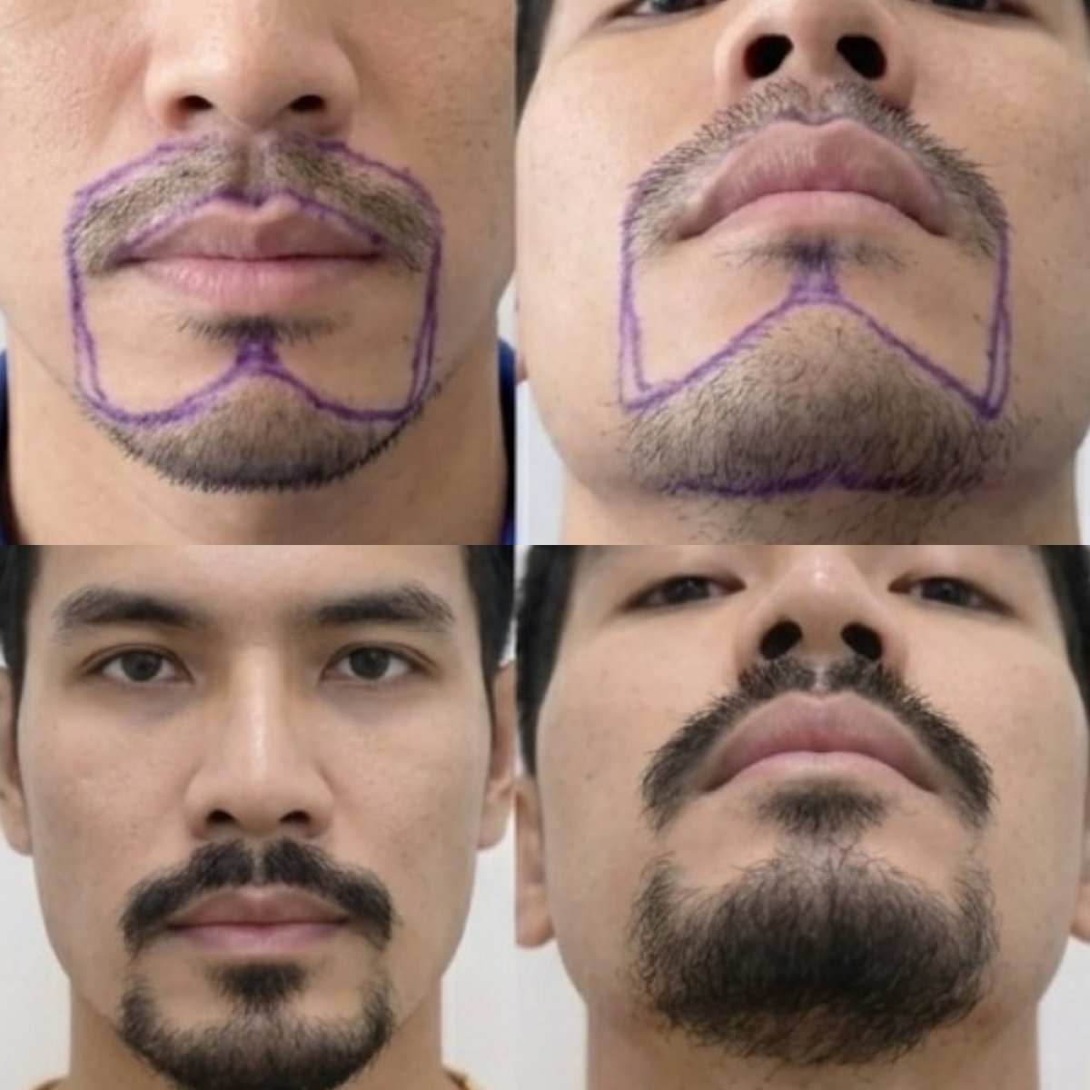 Beard hair transplant before and after results at Department of Skin & Surgery - NAVAMIN9 HOSPITAL