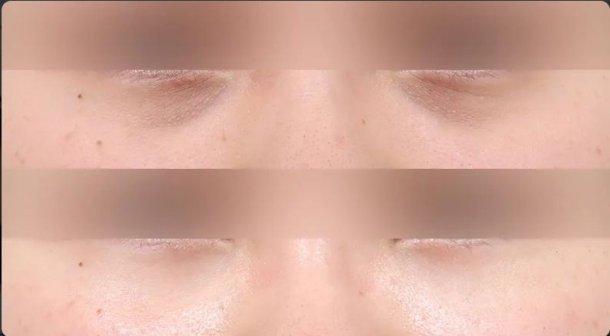 نتائج رأب الجفن السفلي قبل وبعد في AB Plastic Surgery، تقليل الانتفاخات تحت العين