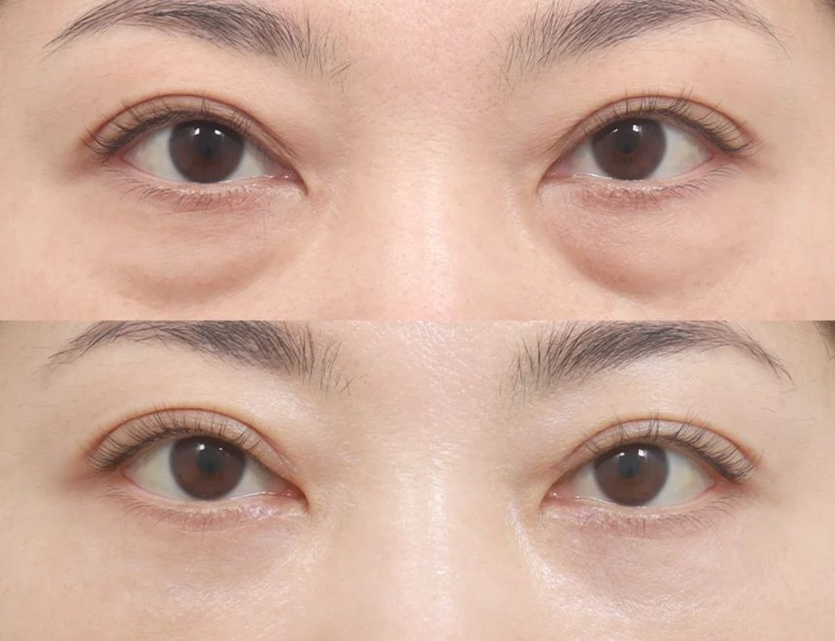Результаты блефаропластики нижних век до и после в AB Plastic Surgery, уменьшены мешки