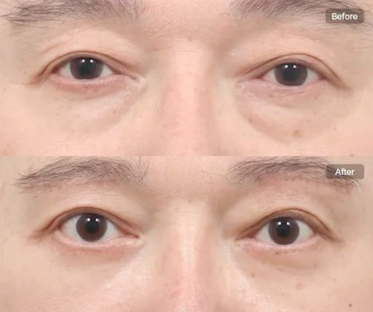 نتائج رأب الجفن السفلي قبل وبعد في AB Plastic Surgery، تقليل الانتفاخ تحت العينين