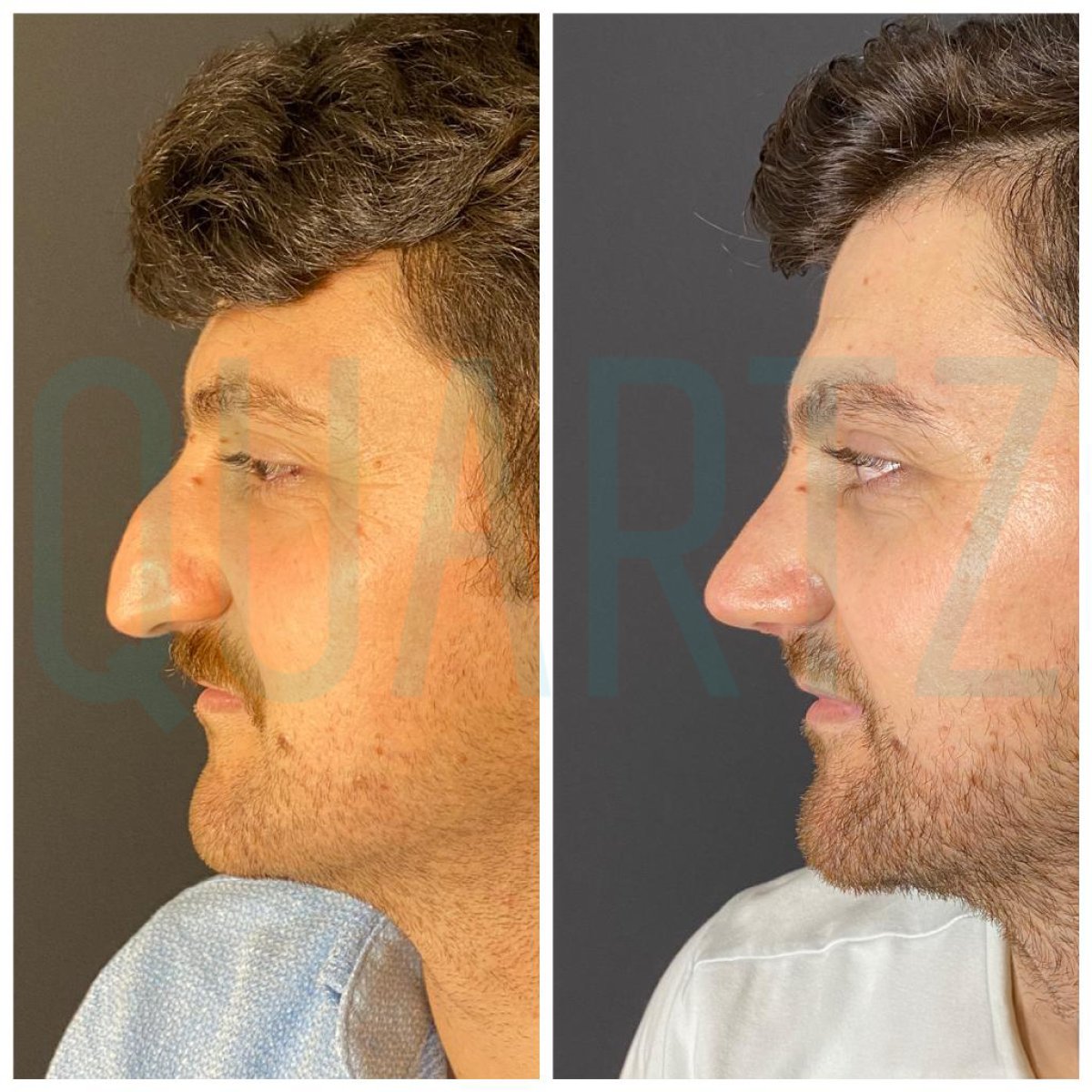 Before and after rhinoplasty results at Quartz Hospital, improved nose shape and profile