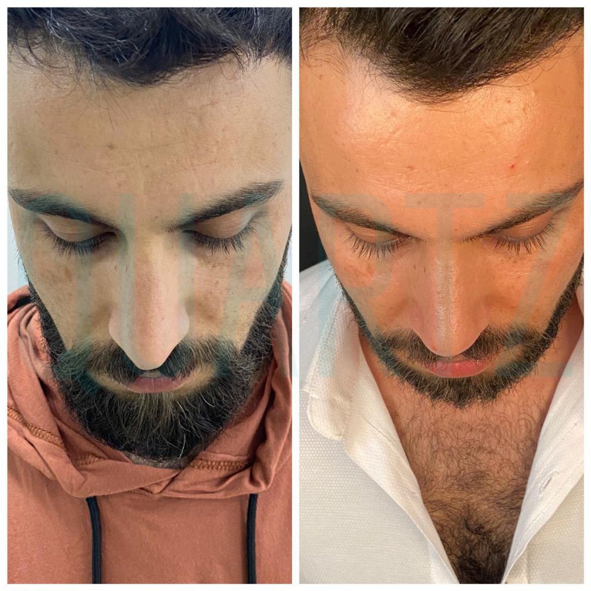 Before and after rhinoplasty results at Quartz Hospital, improved nose shape and symmetry