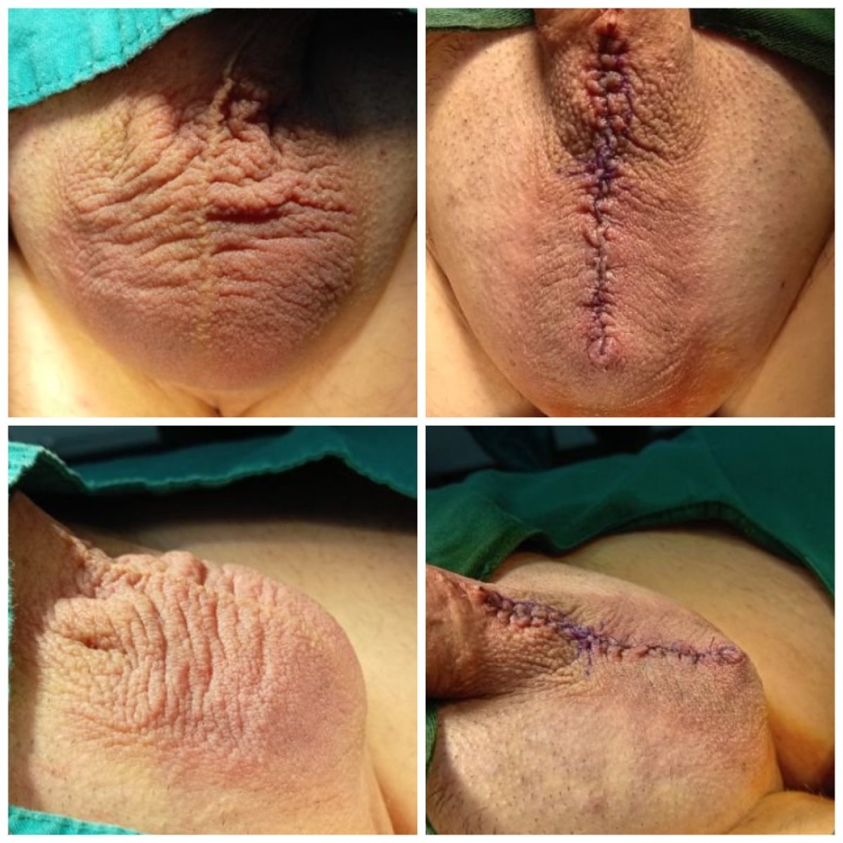 Before and after scrotoplasty results at Menness Wellness Clinic, improved scrotal appearance