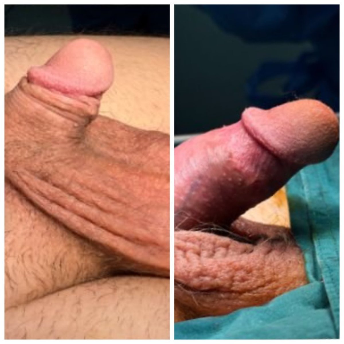 نتائج تكبير القضيب قبل وبعد في عيادة Menness Wellness، زيادة واضحة في الحجم