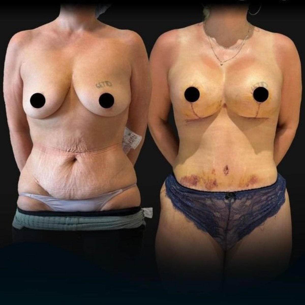 Before and after liposuction results at Soraca Med – visible body contouring improvement