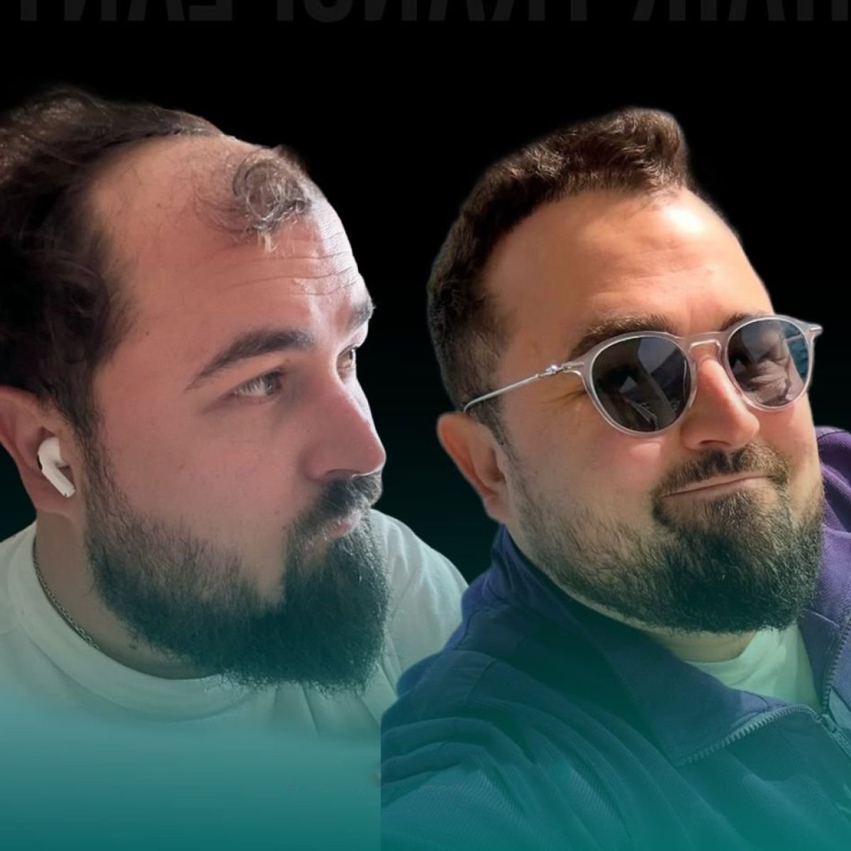 Before and after hair transplant results at Soraca Med – restored hairline and fuller hair