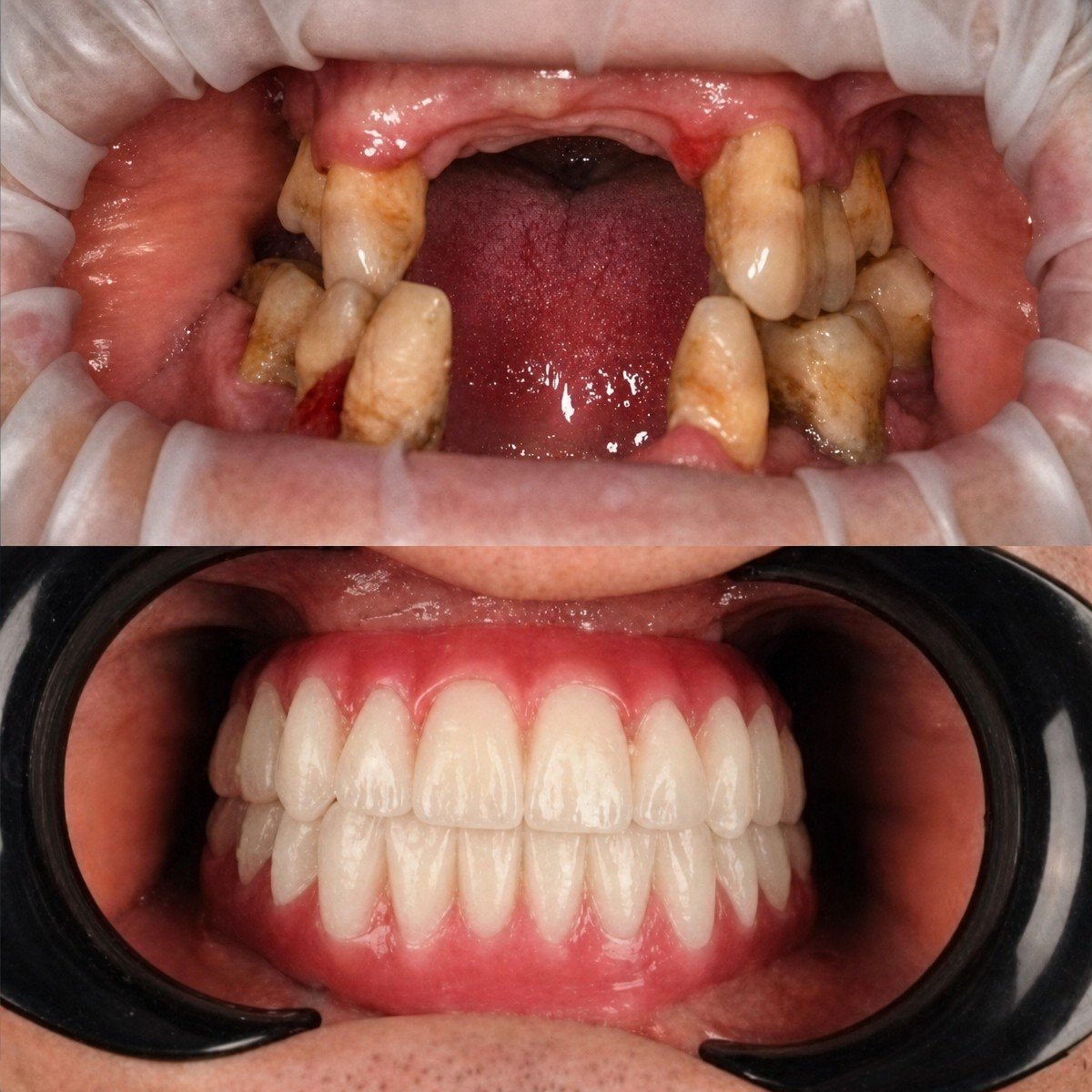 Before and after dental prosthetics installation results at RIKOTA Dental Clinic, smile restored