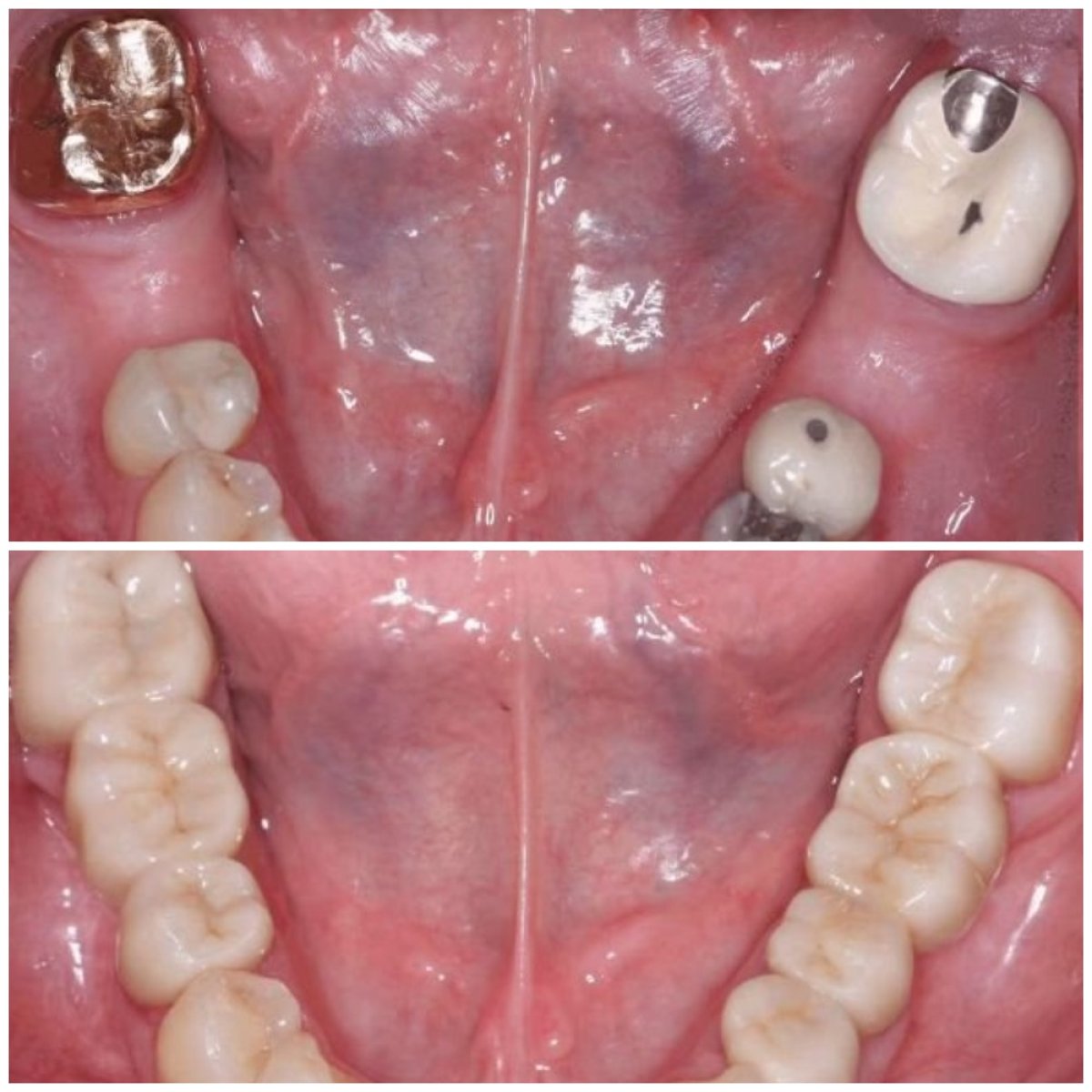 Before and after zirconia dental bridge results at SoftDentalCare Clinic, restored upper teeth