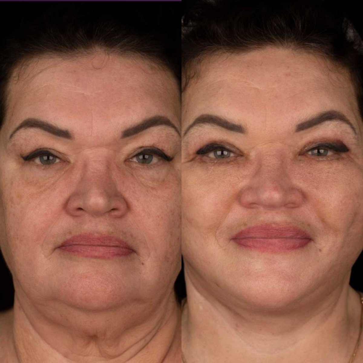 Resultados de lifting de cejas antes y después en Vidnova Clinic – rejuvenecimiento facial