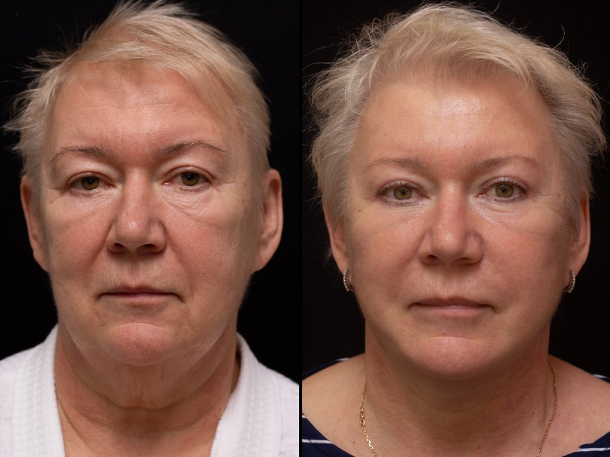 Résultats avant/après lifting des sourcils à la Vidnova Clinic – front et yeux rajeunis