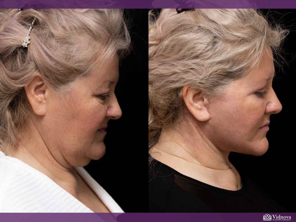 Before and after facelift results at Vidnova Clinic – visible neck and jawline tightening