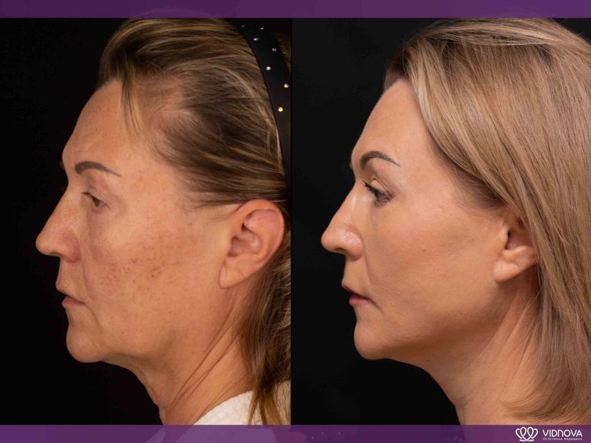 Before and after facelift results at Vidnova Clinic – visible facial rejuvenation and contouring
