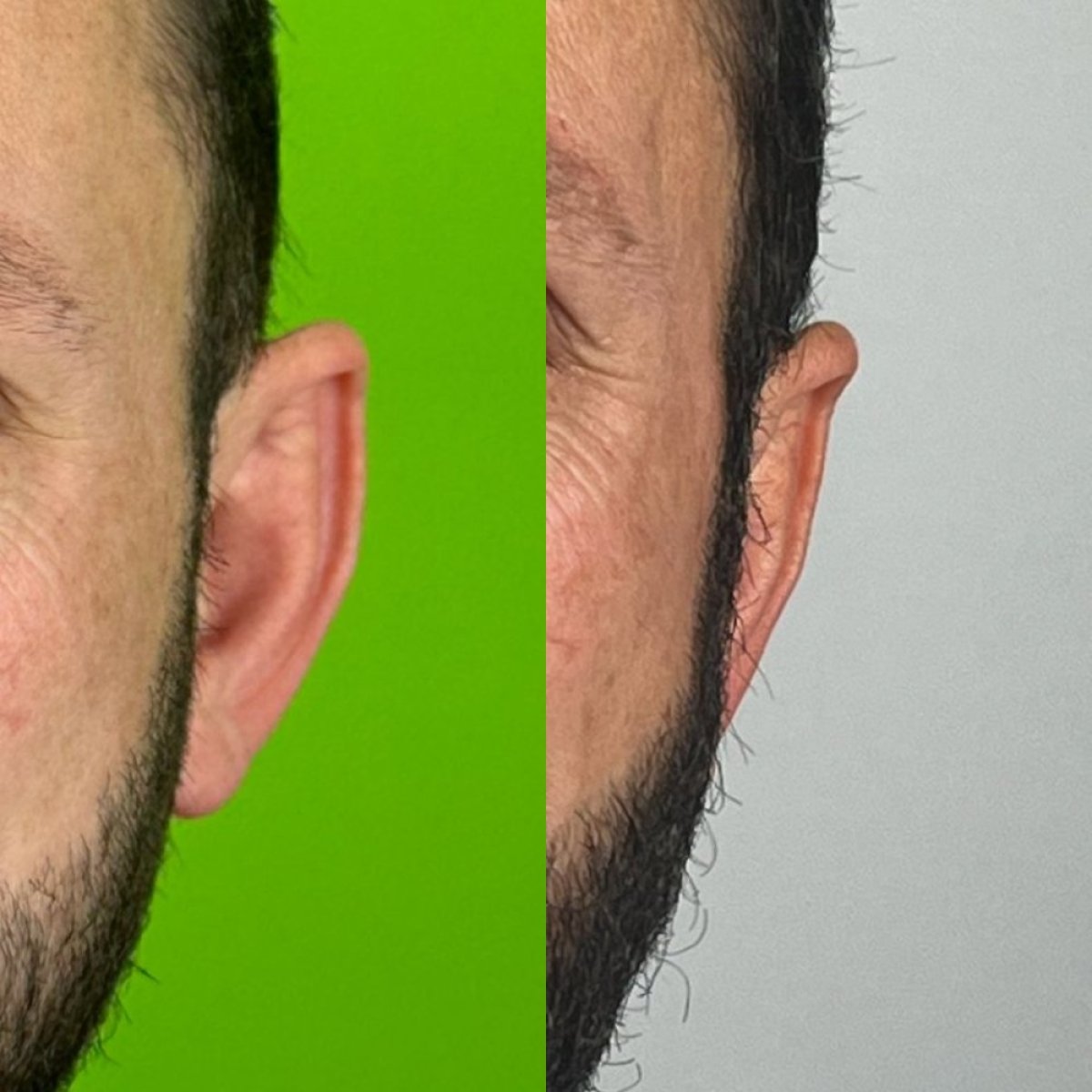 نتائج تجميل الأذن قبل وبعد في عيادة Prof. Dr. Furkan Karabekmez بأنقرة