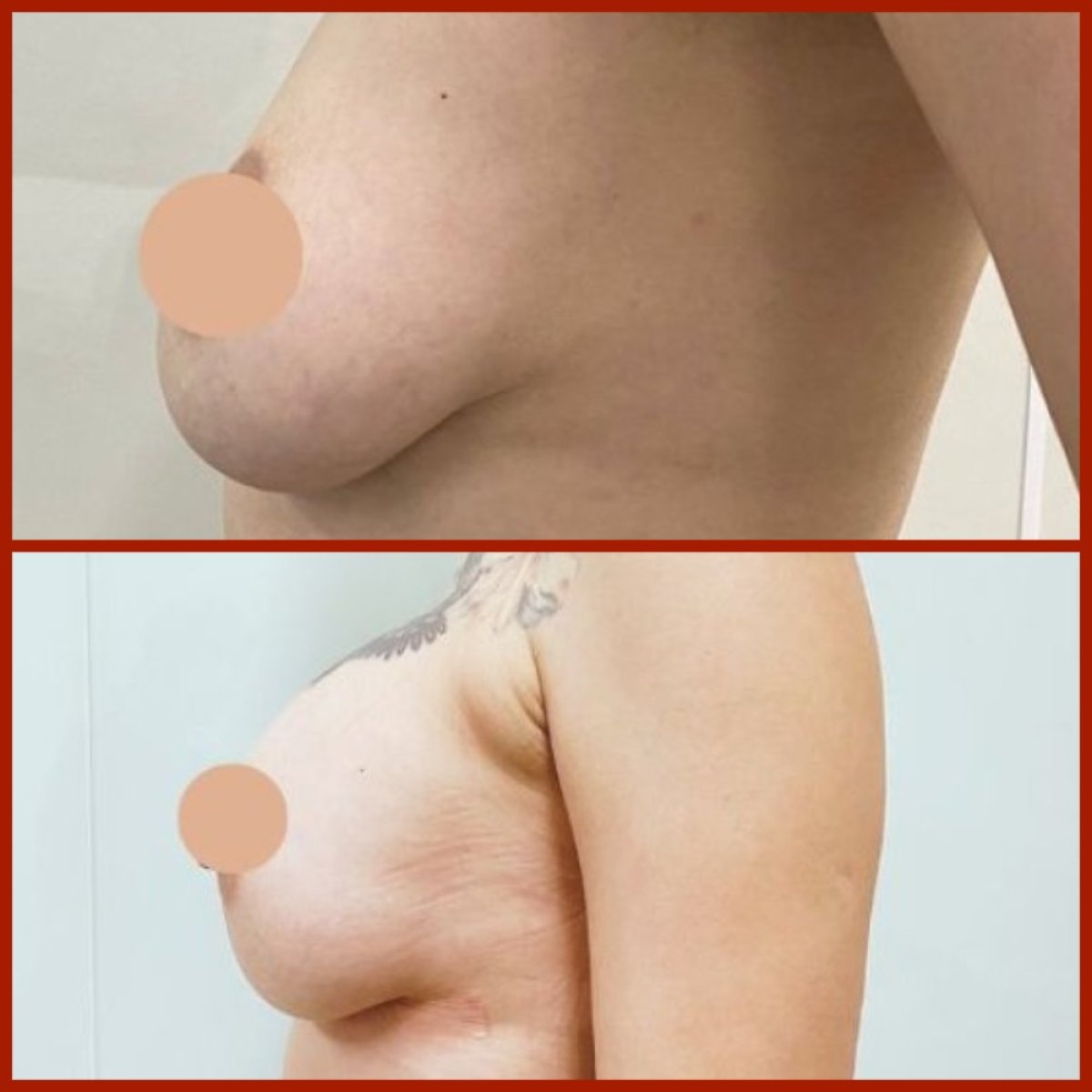 Avant et après augmentation mammaire à la DGB Clinic, lifting visible et forme améliorée