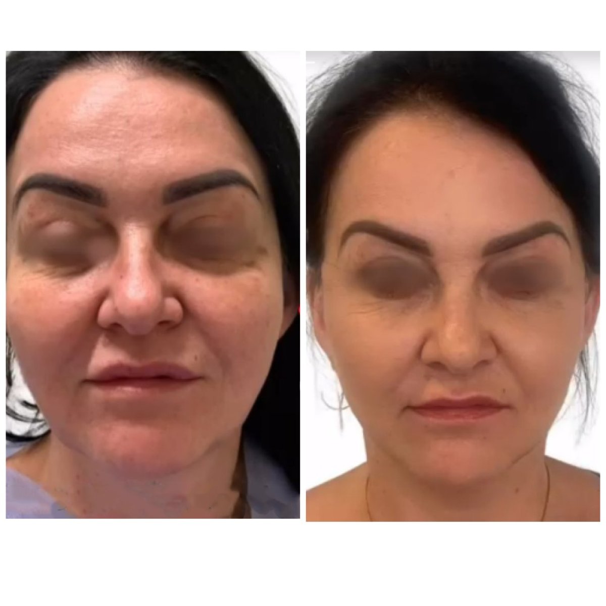 Efekty przed i po Deep Plane Facelift w Radzikowska Clinic, odmłodzenie twarzy