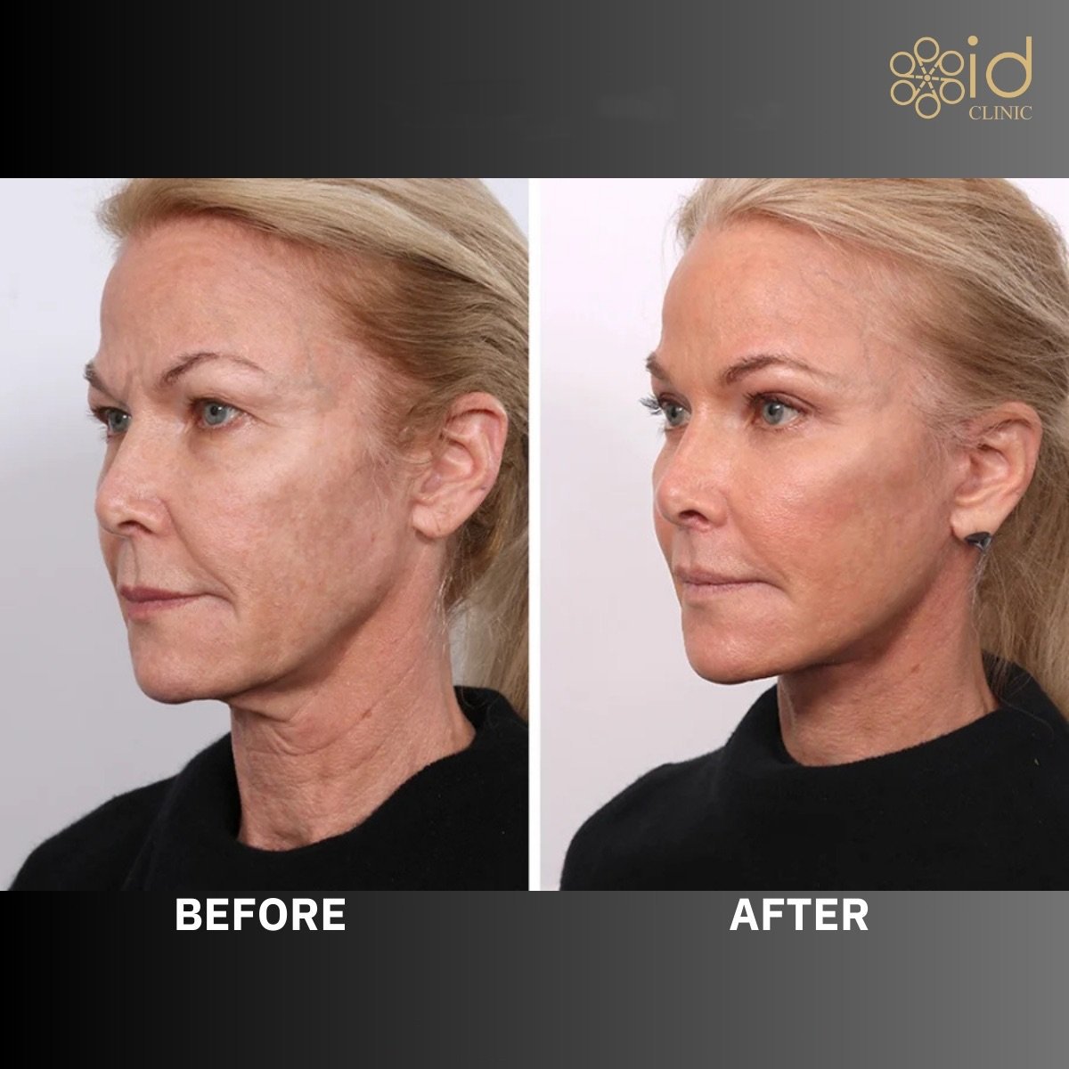 Before and after lower eyelid blepharoplasty results at ID Clinic Bangkok, rejuvenated appearance