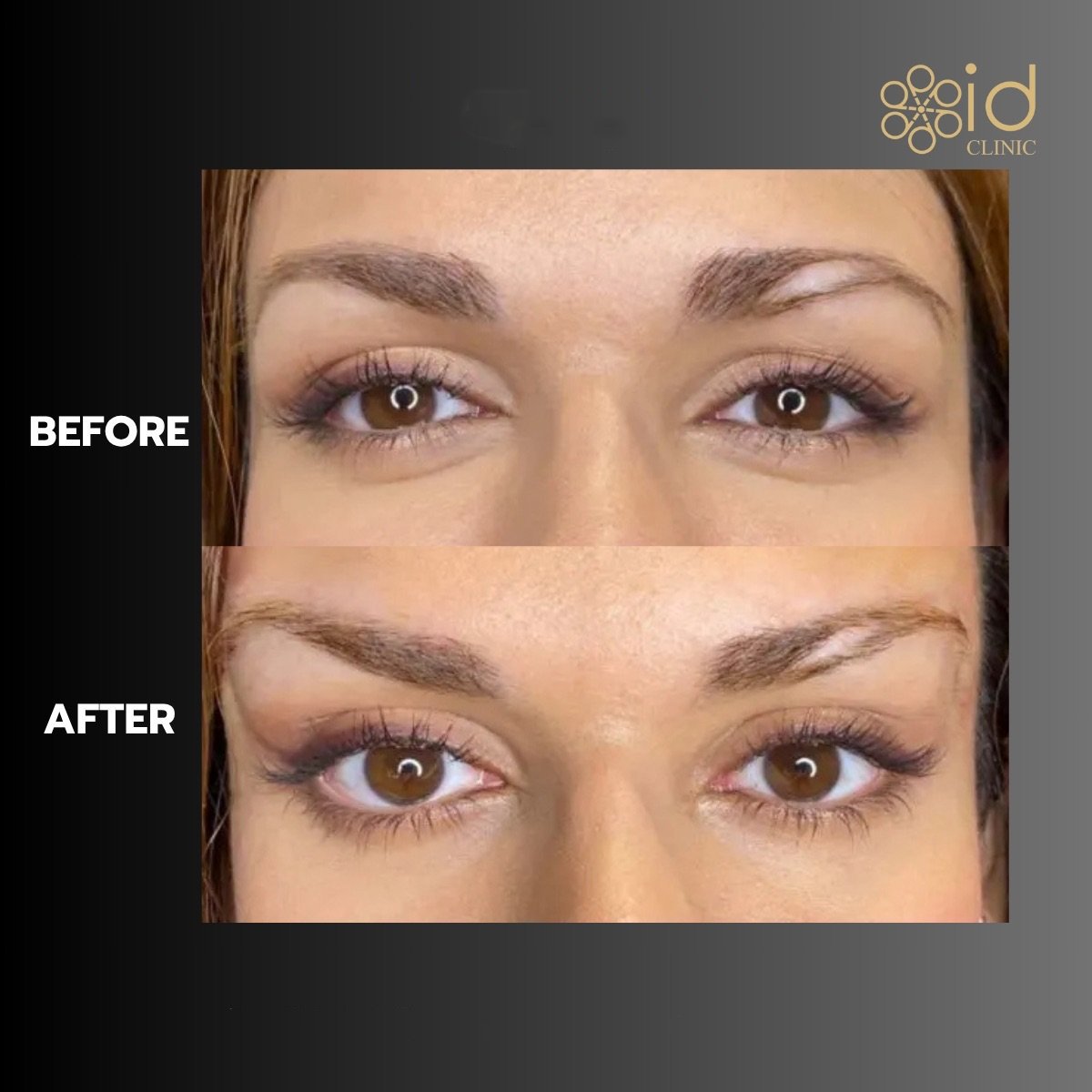 Before and after lower eyelid blepharoplasty results at ID Clinic Bangkok, eye rejuvenation