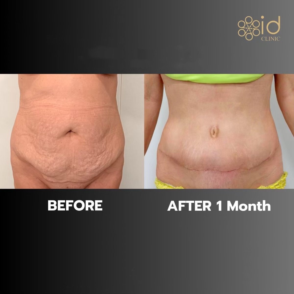 Before and after liposuction results at ID Clinic Bangkok, visible abdomen contour improvement