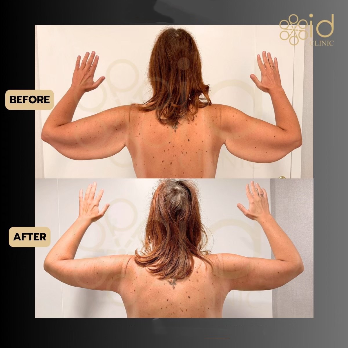 Before and after arm lift (brachioplasty) results at ID Clinic Bangkok, improved arm contour