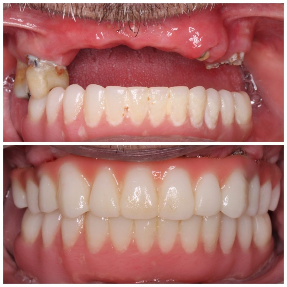 Before and after dental implant results – restored full smile and improved oral health