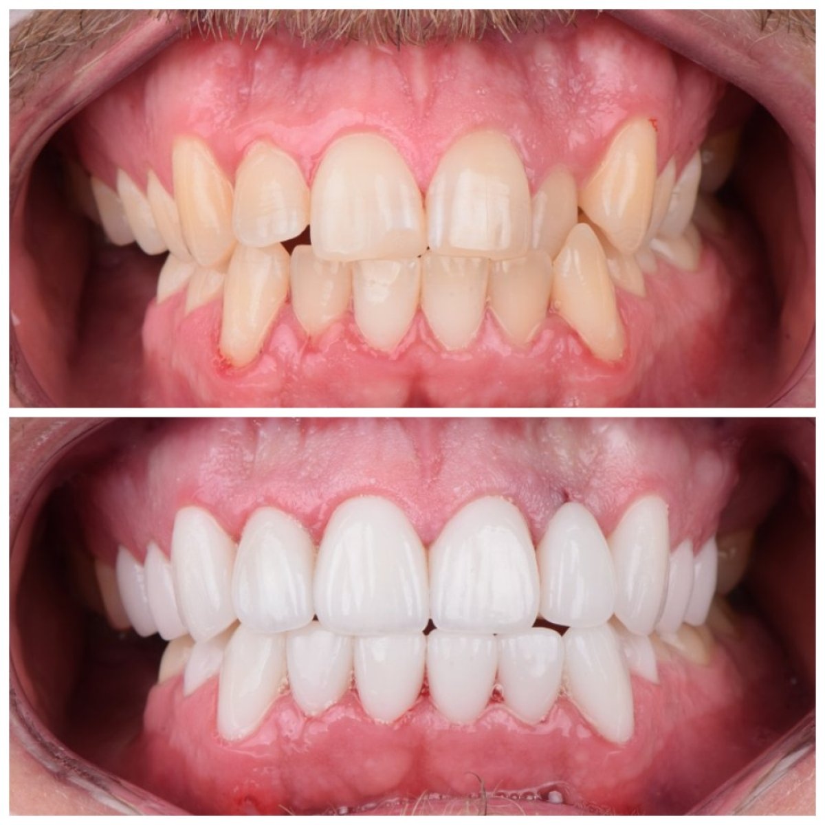 Before and after dental veneers result – improved smile and aligned teeth transformation