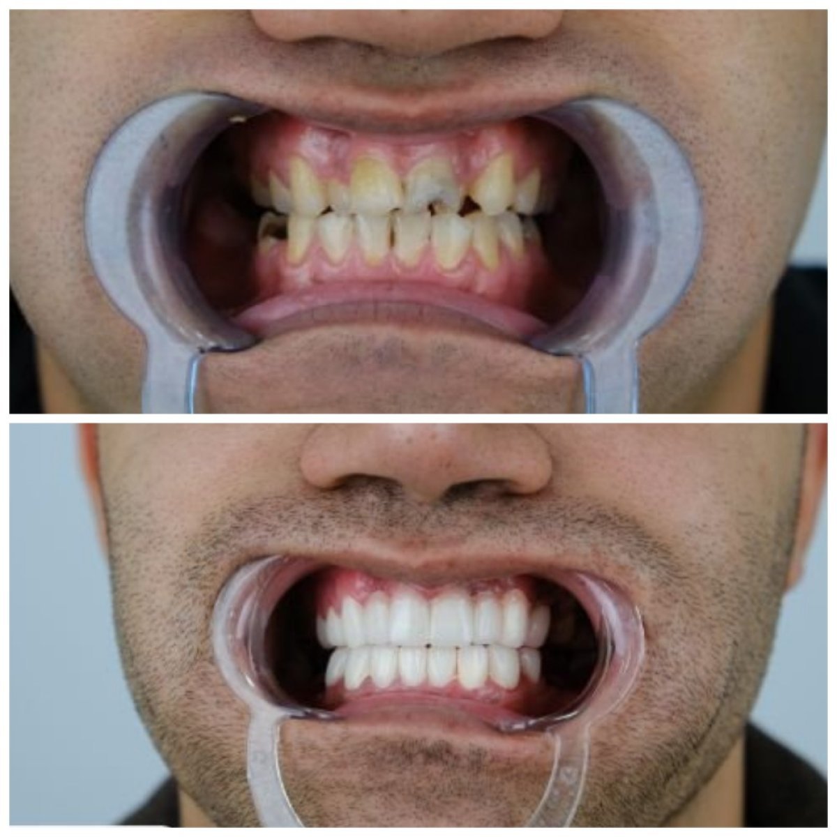 Resultados antes y después de implantes dentales en YEG Clinic – sonrisa restaurada