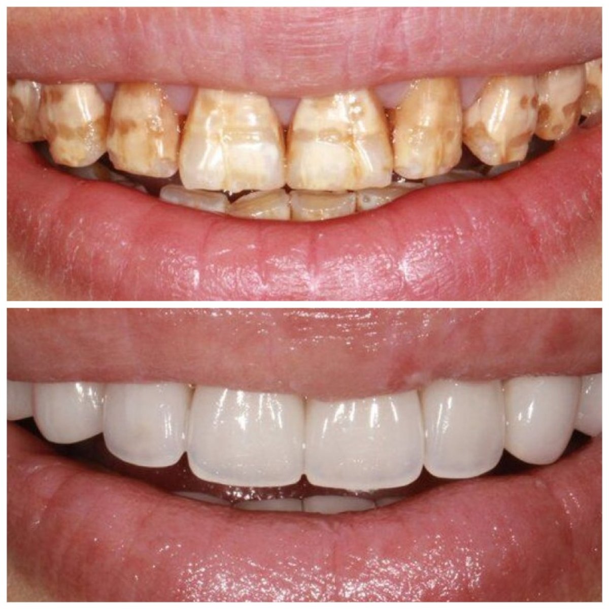 Antes y después de carillas dentales en Xiamen Humanity Hospital: resultados de sonrisa
