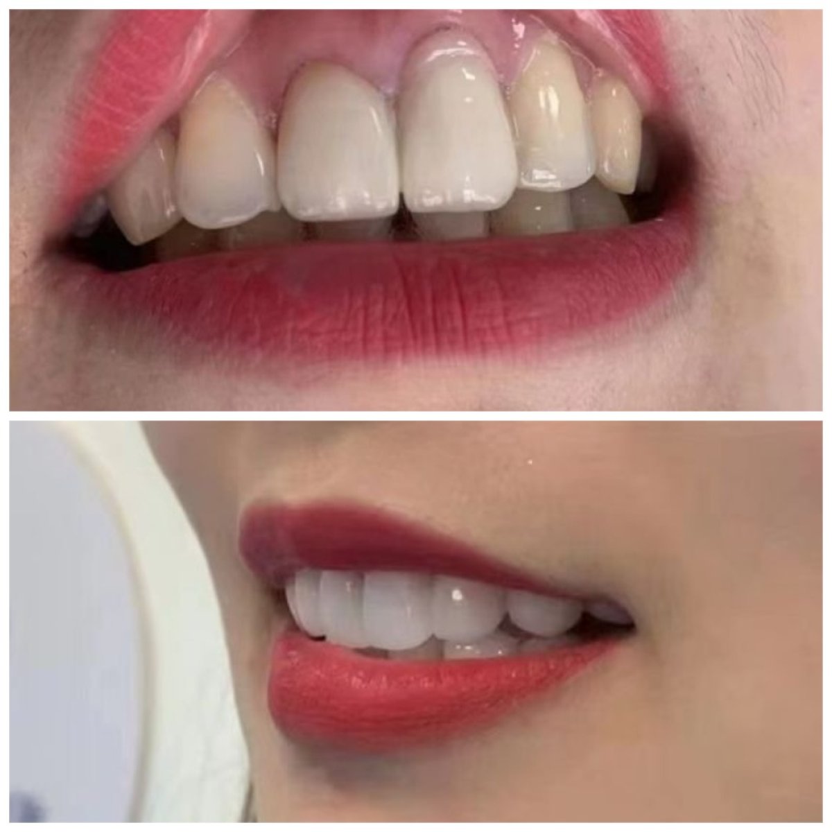 Antes y después de carillas dentales en Xiamen Humanity Hospital – mejora estética de la sonrisa