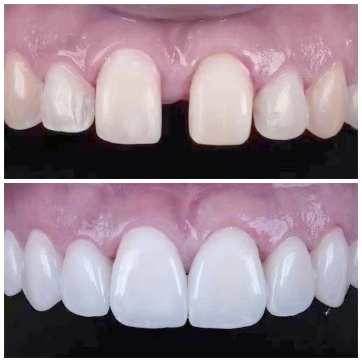 Antes y después de carillas dentales en Xiamen Humanity Hospital – sonrisa natural mejorada