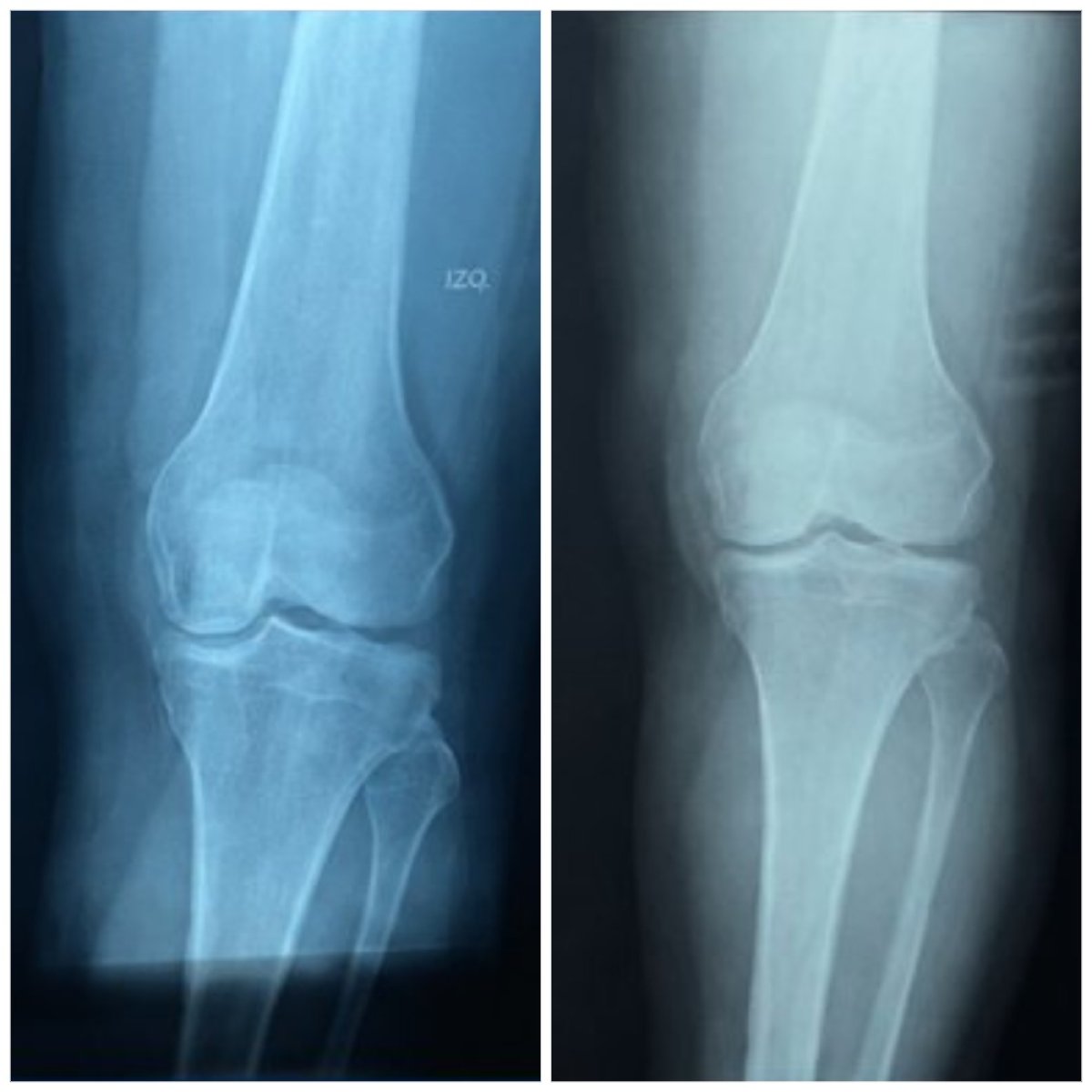 Resultados antes y después del tratamiento con células madre para artrosis en CellsClinic