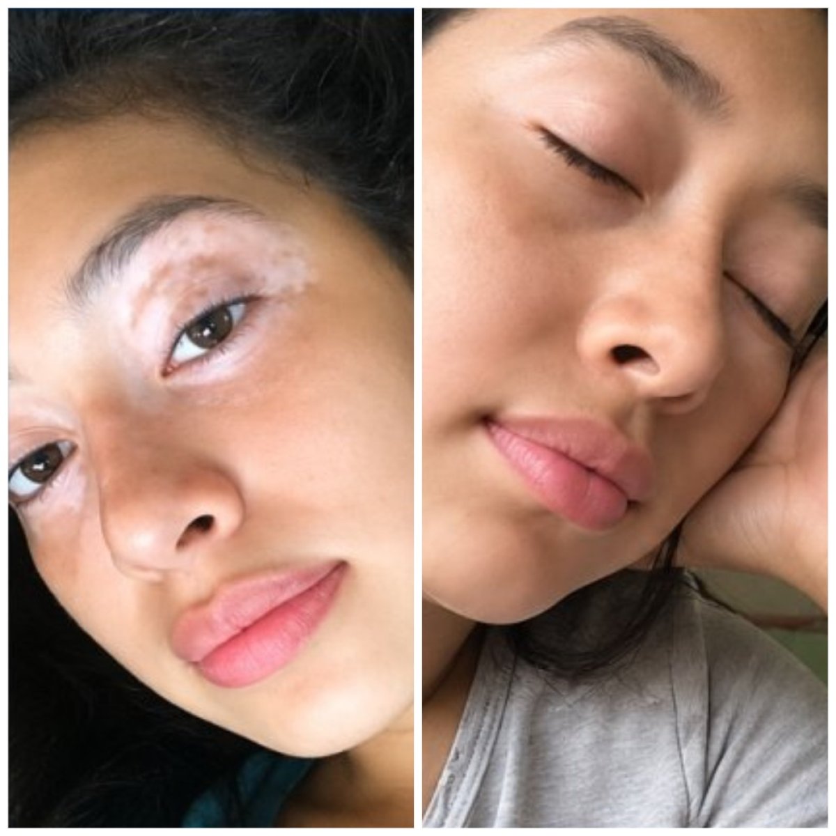 Vitiligo treatment before and after result with donor stem cells at CellsClinic Regenerative Medicine Center